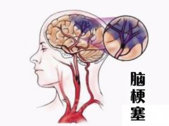 養成好的生活習慣，能夠有效預防腦梗塞